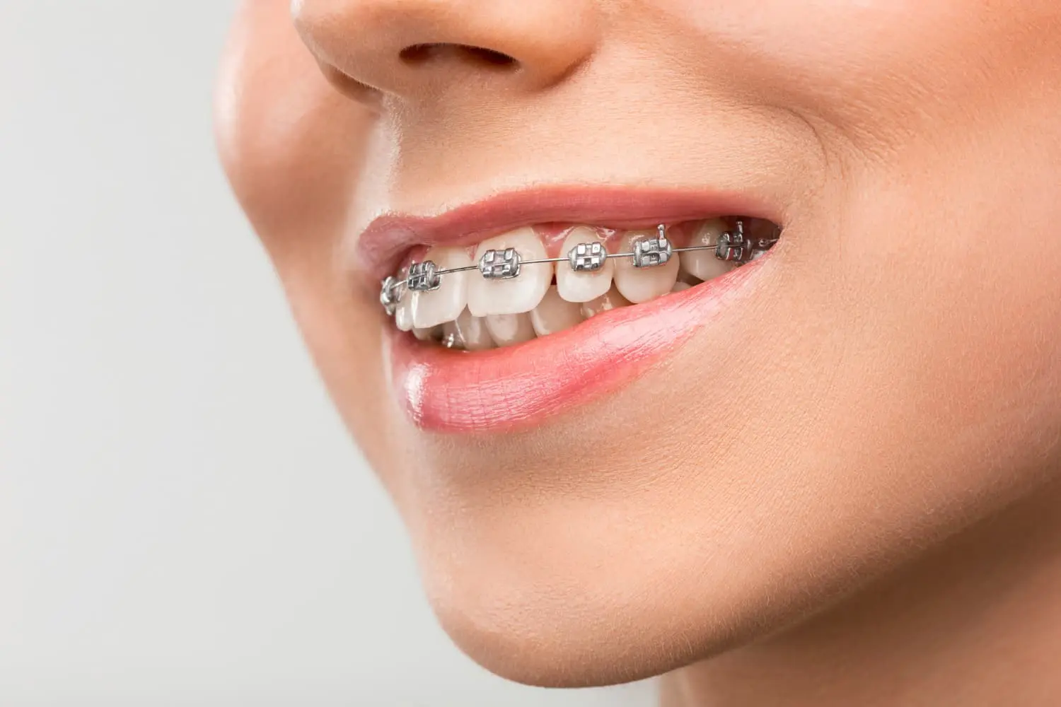 Close-up of a person smiling, revealing metal braces designed to correct an overbite in Suwanee or Tucker, GA