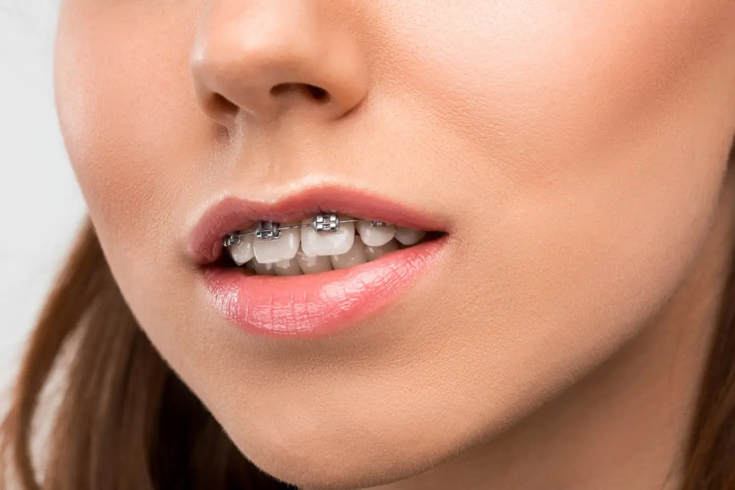 Close-up of a woman's mouth with an overbite, showcasing metal braces on her teeth. Her lips are slightly parted, revealing part of her braces and addressing the alignment issue in Suwanee or Tucker, GA