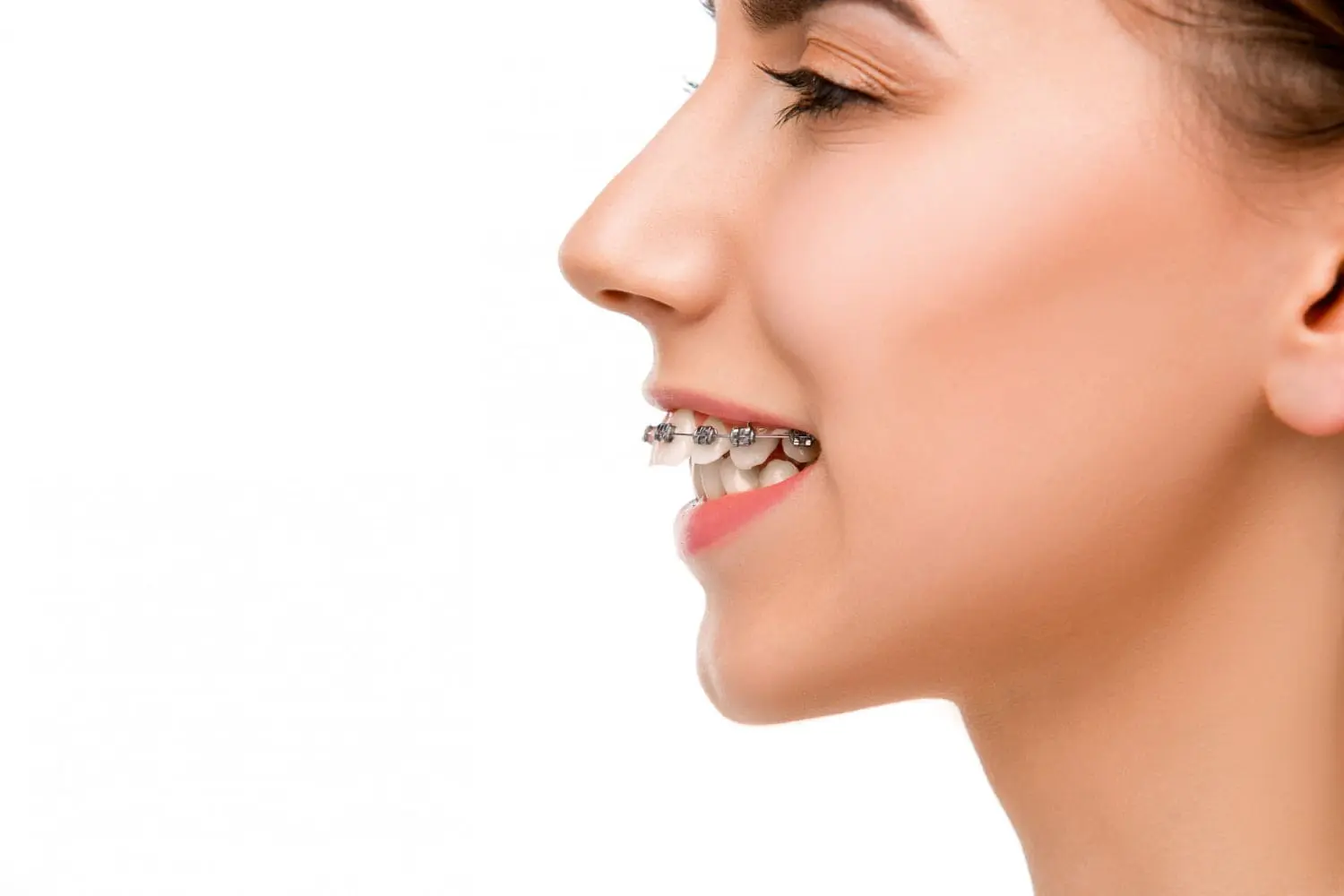 A side profile of a person with an overbite showcases their smile with braces against a pristine white background in Suwanee or Tucker, GA