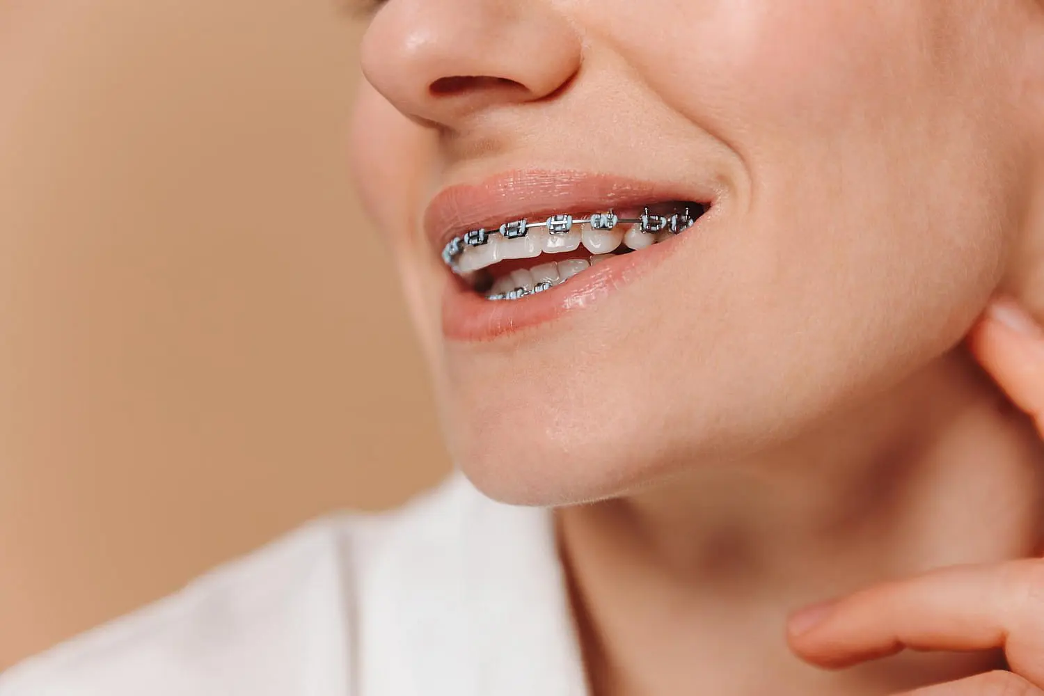 Close-up of a person smiling, revealing metal dental braces correcting an overbite against a plain background in Suwanee or Tucker, GA