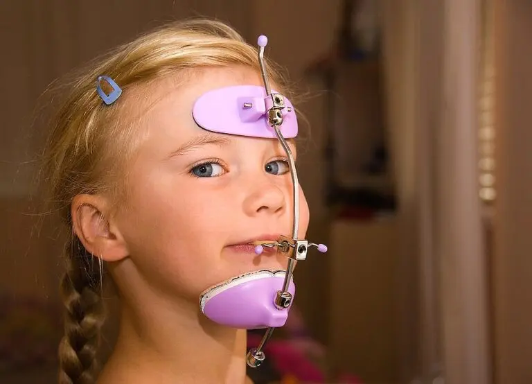 A young girl from NK Orthodontics wears a headgear appliance with purple pads for orthodontic correction, maintaining a neutral expression in Suwanee and Tucker, GA