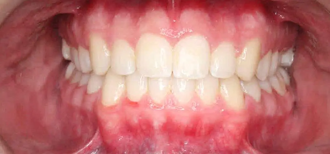 Close-up of a person's teeth from NK Orthodontics at Suwanee, GA, showcasing both upper and lower dental arches - after completing the invisalign treatment.