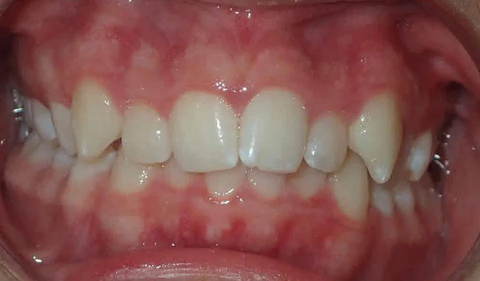 Close-up of a person's teeth from NK Orthodontics at Suwanee, GA, showcasing both upper and lower dental arches - beginning of invisalign treatment.