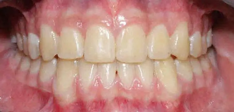 Close-up of a person's teeth from NK Orthodontics at Tucker, GA, showcasing both upper and lower dental arches - after completing the invisalign treatment.