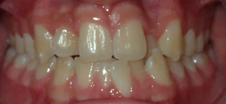 Close-up of a person's teeth from NK Orthodontics at Tucker, GA, showcasing both upper and lower dental arches - beginning of invisalign treatment.