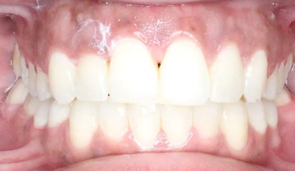 Close-up of a person's teeth from NK Orthodontics at Suwanee or Tucker, GA, showcasing both upper and lower dental arches - after completing the adult braces fix.