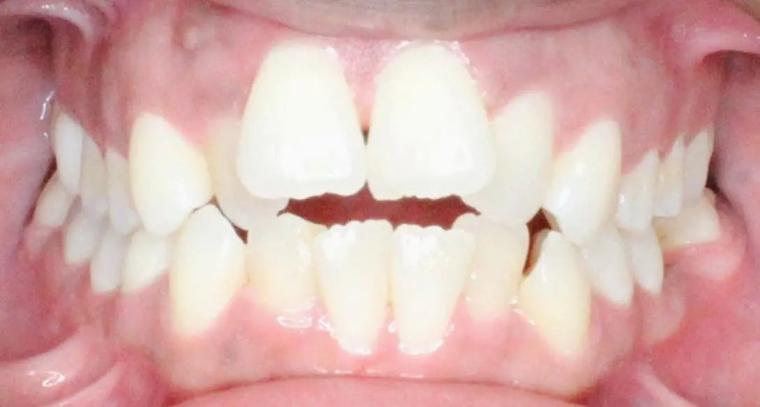 Close-up of a person's teeth from NK Orthodontics at Suwanee or Tucker, GA, showcasing both upper and lower dental arches - beginning of adult braces fix