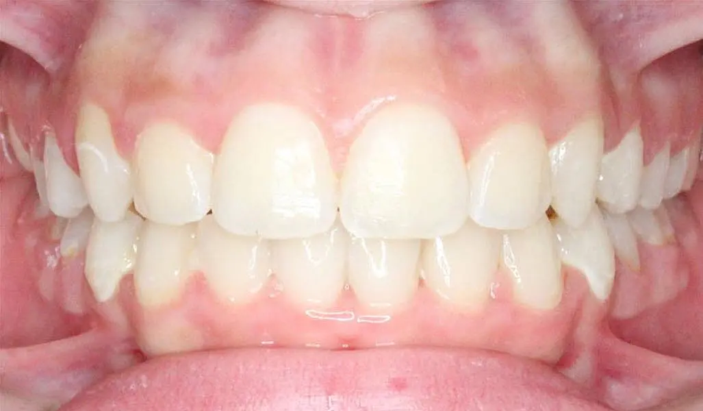 Close-up of a person's teeth from NK Orthodontics at Suwanee or Tucker, GA, showcasing both upper and lower dental arches - after completing the children braces fix.