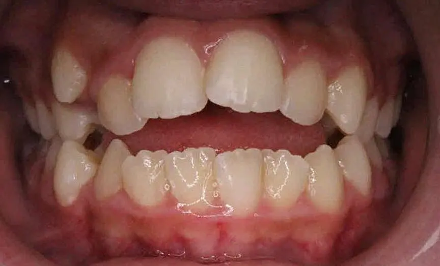 Close-up of a person's teeth from NK Orthodontics at Suwanee or Tucker, GA, showcasing both upper and lower dental arches - beginning of children braces fix
