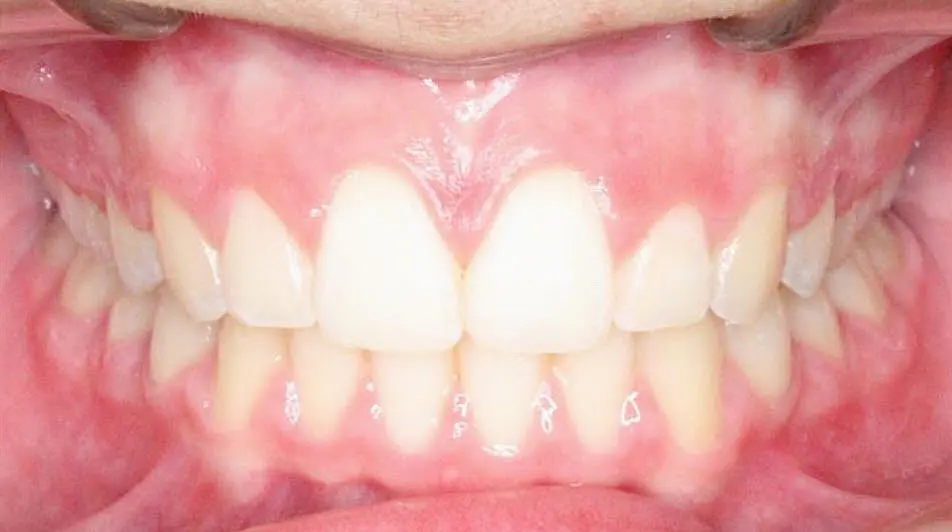 Close-up of a person's teeth from NK Orthodontics at Suwanee, GA, showcasing both upper and lower dental arches - after completing the invisalign treatment.
