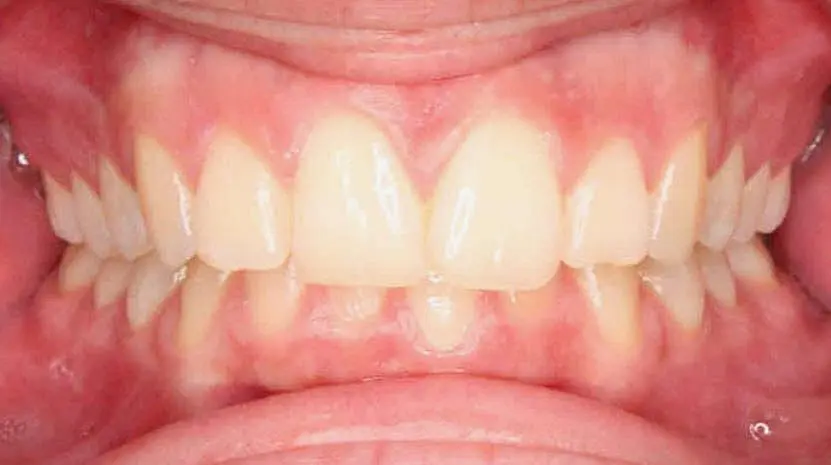 Close-up of a person's teeth from NK Orthodontics at Suwanee, GA, showcasing both upper and lower dental arches - beginning of invisalign treatment.