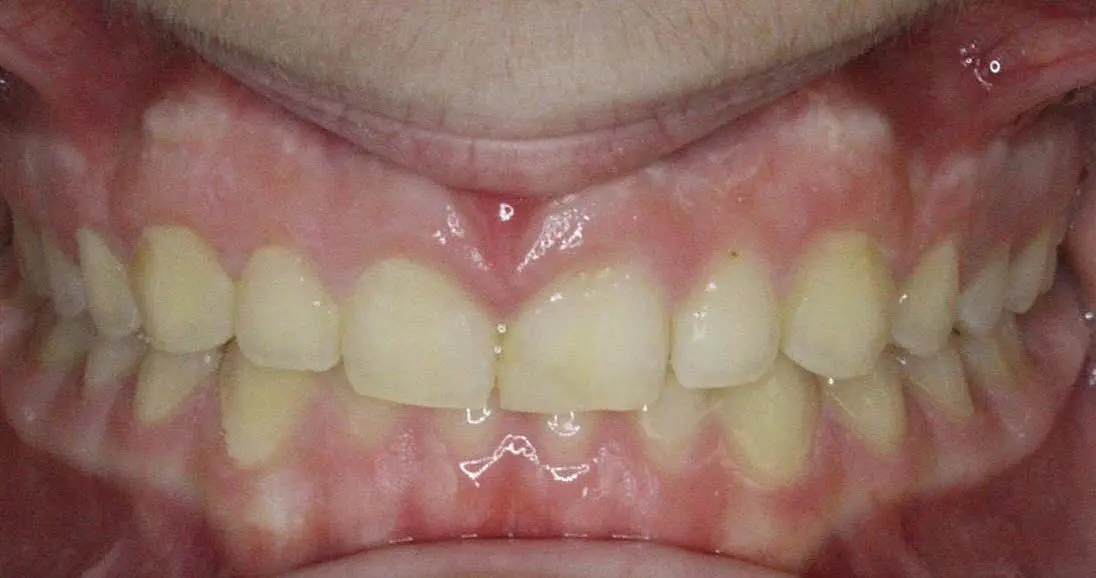 Close-up of a person's teeth from NK Orthodontics at Tucker, GA, showcasing both upper and lower dental arches - after completing the invisalign treatment.