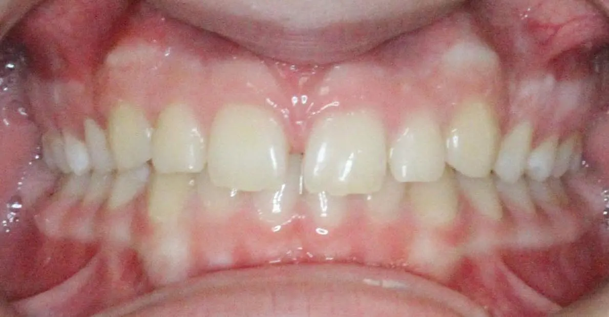 Close-up of a person's teeth from NK Orthodontics at Tucker, GA, showcasing both upper and lower dental arches - beginning of invisalign treatment.