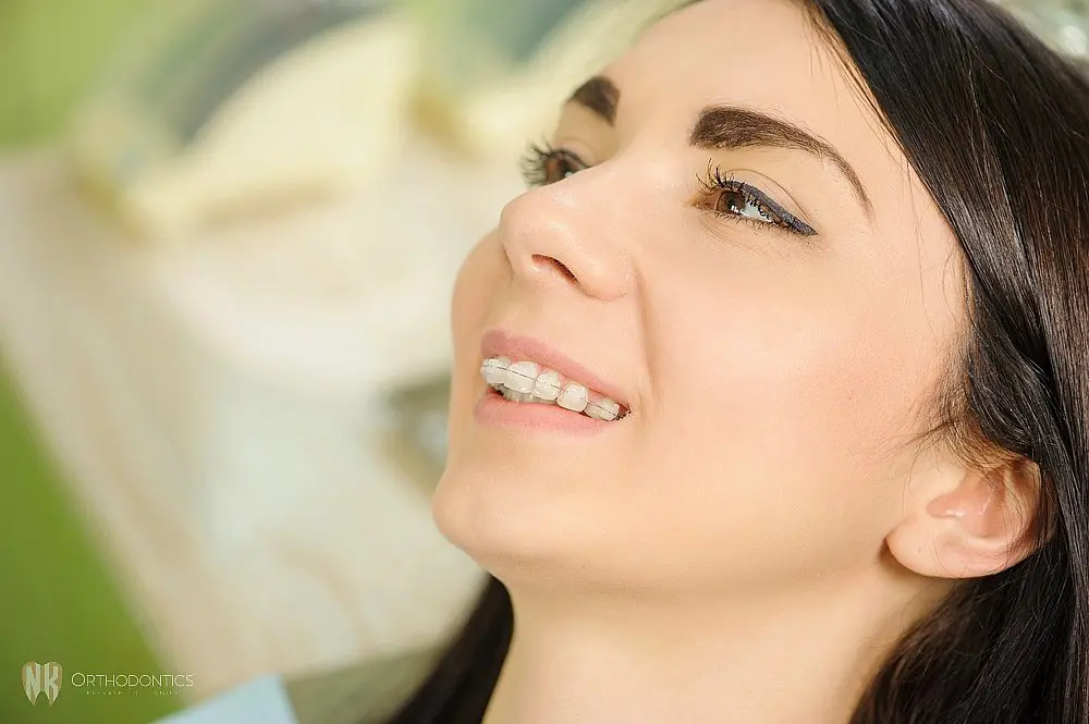 Close-up of a smiling patient showing clear braces for overbite in suwanee and tucker, ga on teeth.