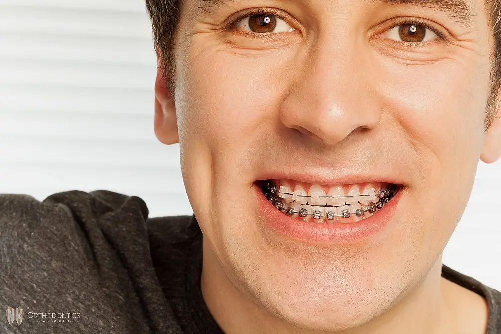 happy young man with metal braces - Overbite vs Underbite in Suwanee and Tucker, GA. 
