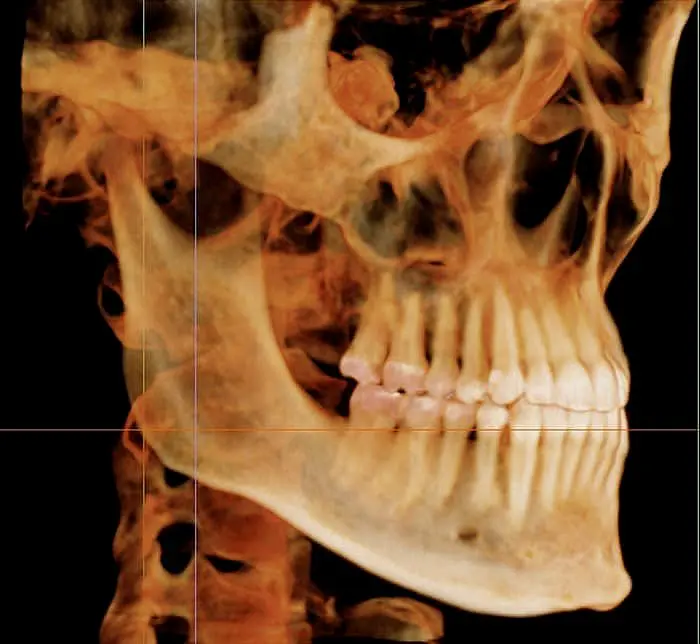 3D rendered X-ray image showing a side view of a human skull and jaw, displaying teeth and bone structure in detail.