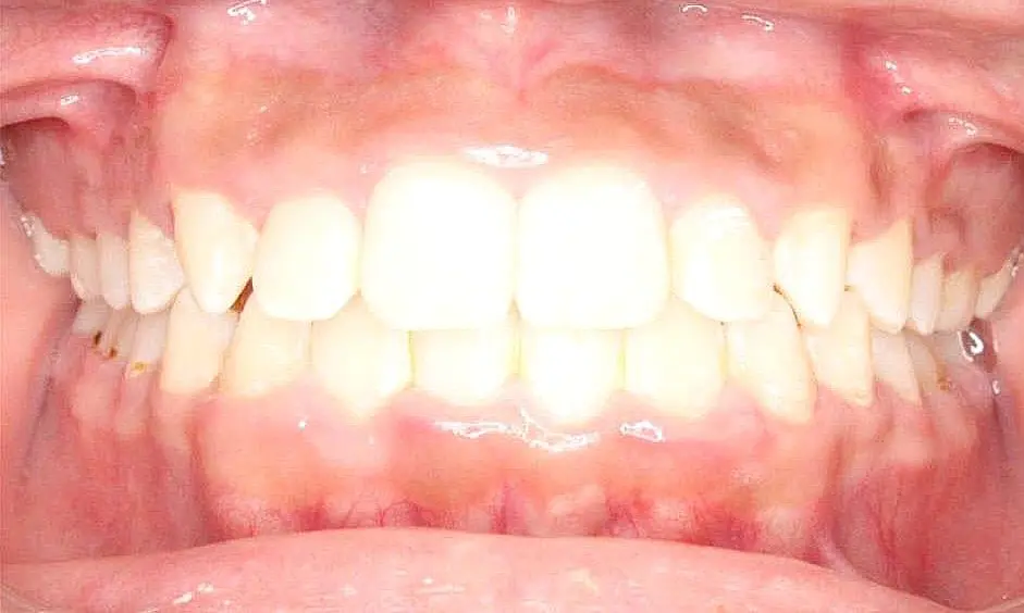 Close-up of a person's teeth from NK Orthodontics at Suwanee, GA, showcasing both upper and lower dental arches - after completing the braces treatment.