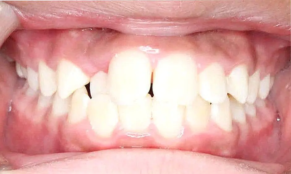 Close-up of a person's teeth from NK Orthodontics at Suwanee, GA, showcasing both upper and lower dental arches - beginning of braces treatment.