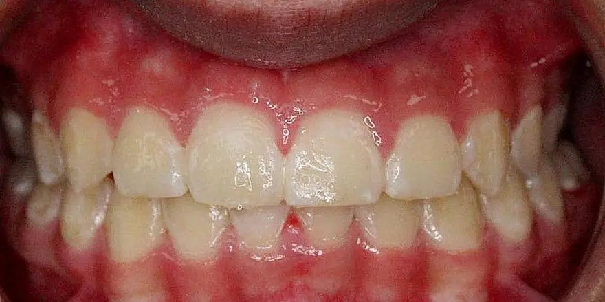 Close-up of a person's teeth from NK Orthodontics at Tucker, GA, showcasing both upper and lower dental arches - after completing the braces treatment.