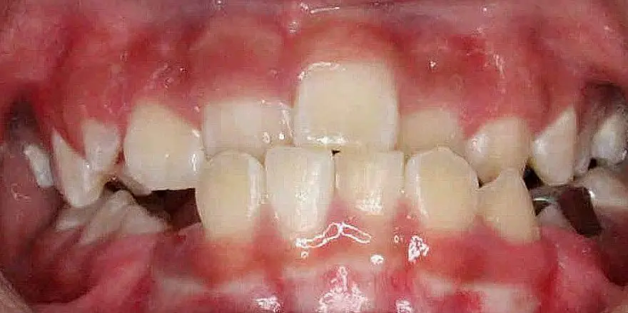 Close-up of a person's teeth from NK Orthodontics at Tucker, GA, showcasing both upper and lower dental arches - beginning of braces treatment.