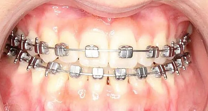 Close-up of a person's teeth from NK Orthodontics at Tucker, GA, showcasing both upper and lower dental arches - after completing the braces treatment.