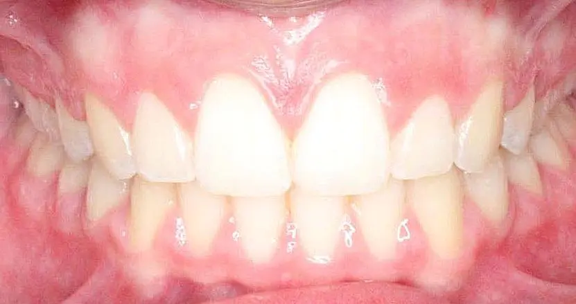 Close-up of a person's teeth from NK Orthodontics at Suwanee, GA, showcasing both upper and lower dental arches - after completing the invisalign treatment.