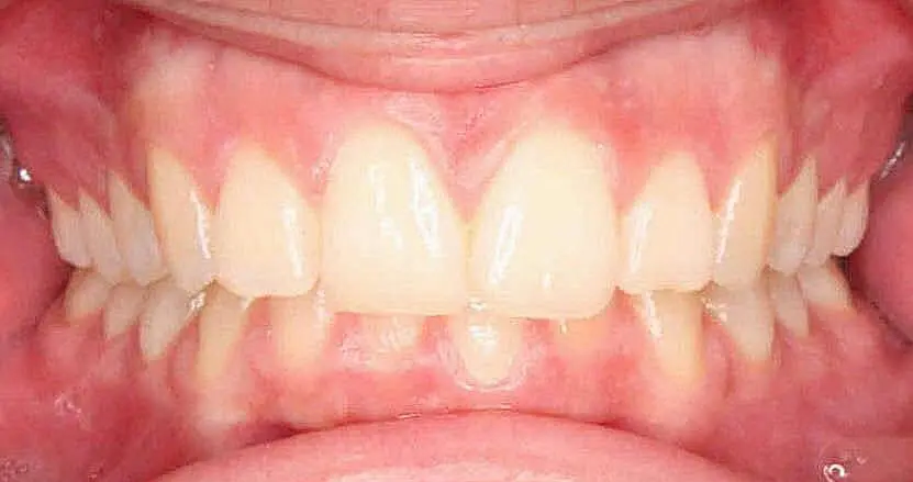 Close-up of a person's teeth from NK Orthodontics at Suwanee, GA, showcasing both upper and lower dental arches - beginning of invisalign treatment.